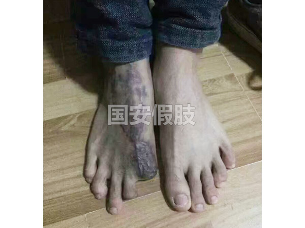 長沙國安假肢康復用品有限公司,長沙假肢用品,國安假肢康復用品,假肢矯形器,康復器材,假肢配件,矯形器支具