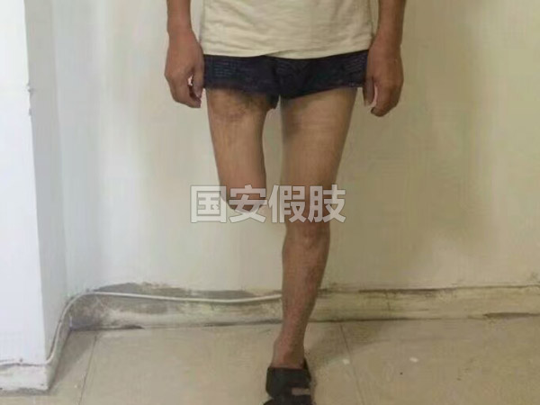 長沙國安假肢康復用品有限公司,長沙假肢用品,國安假肢康復用品,假肢矯形器,康復器材,假肢配件,矯形器支具